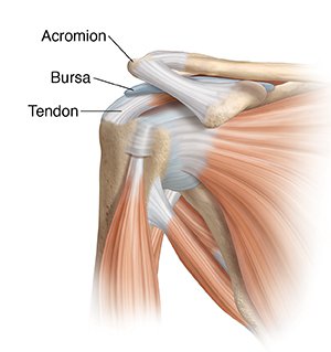 SHOULDER IMPINGEMENT