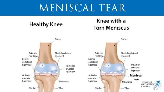 MENISCAL TEAR