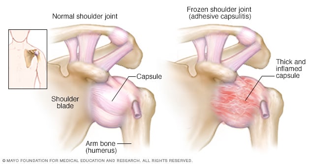 frozen shoulder