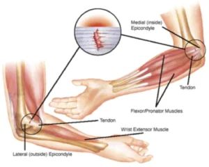 Golfer’s Elbow