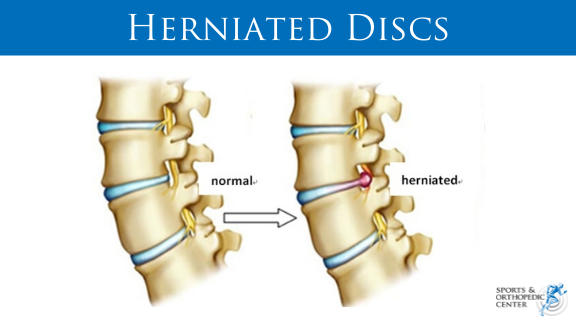 Herniated Disk 