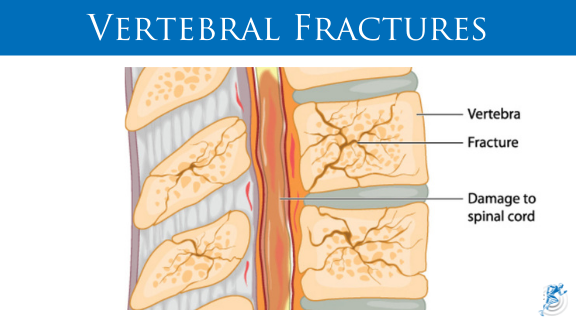 Spine Injuries from a Car Accident