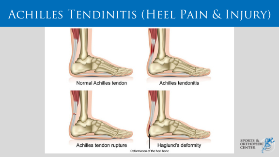 Achilles tendinitis deals